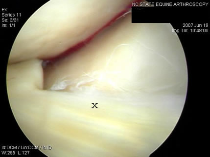 Rotator cuff tear - Wikipedia, the free.